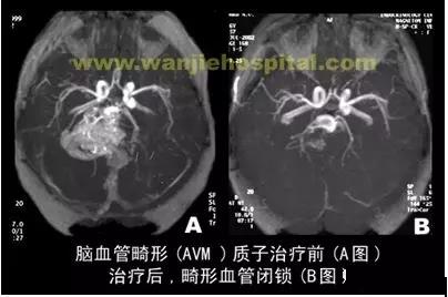 脑动静脉畸形(AVM)质子治疗效果