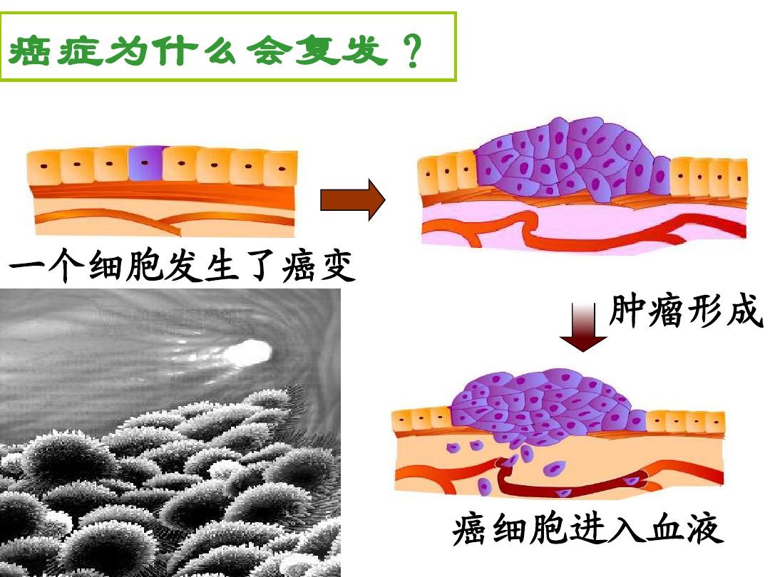 癌症为什么会复发、原因有哪些,如何预防癌症复发