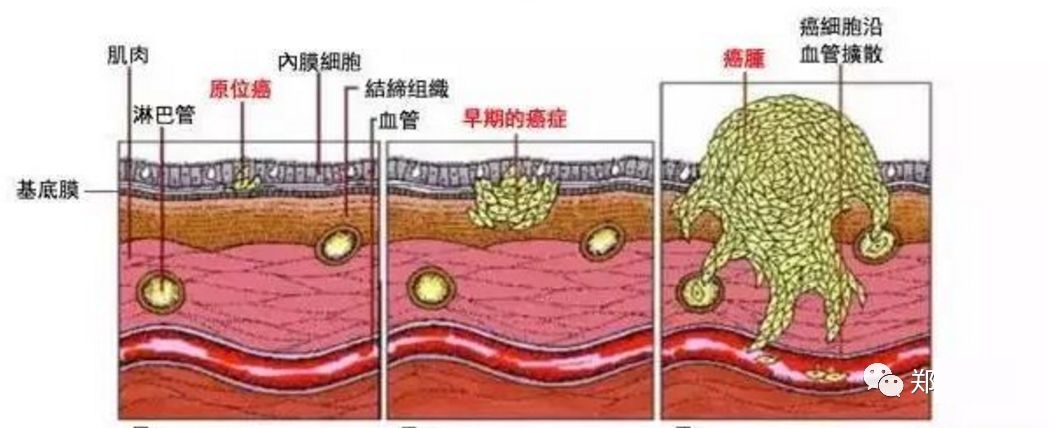 肺癌能治好吗