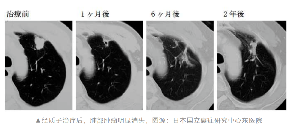 肺癌质子治疗效果怎么样