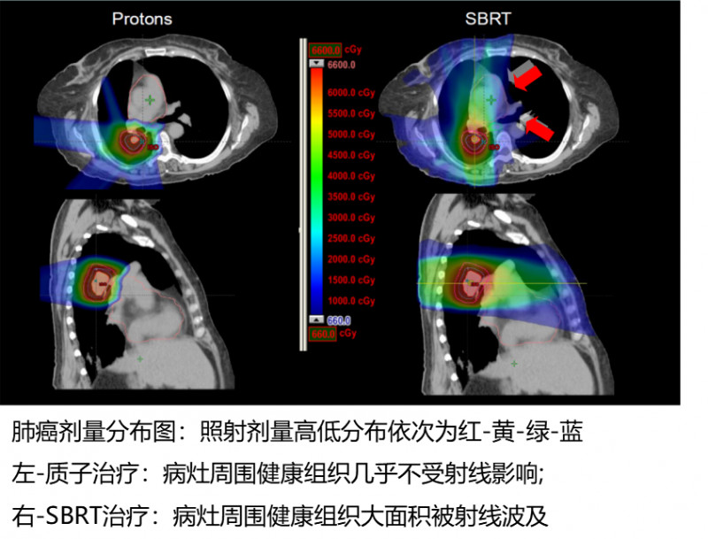 肺癌质子治疗价格