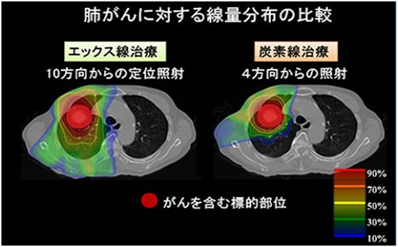 肺癌重离子治疗好还是手术好,日本重离子治疗肺癌局部控制率达97.6%效果可媲美手术