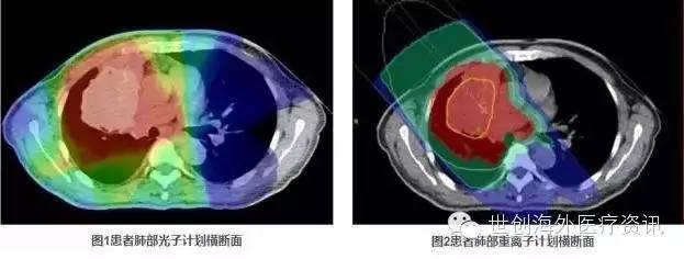 肺癌质子重离子治疗和手术哪个好