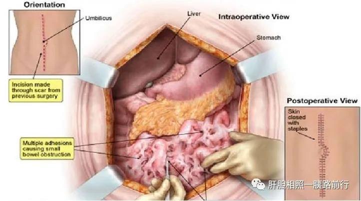 胃癌开腹手术