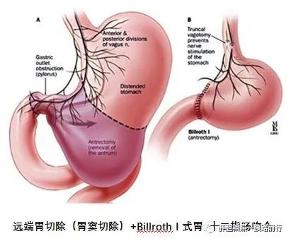 胃癌Billroth I式