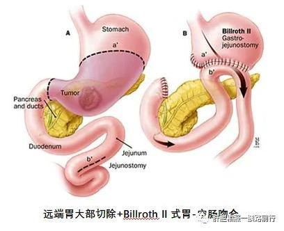 胃癌Billroth II式