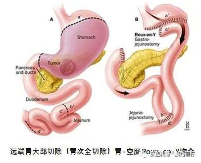 远端胃大部分切除胃-空肠Roux-en-Y吻合
