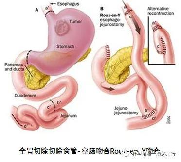 全胃切除切除食管-空肠吻合Roux-en-Y吻合