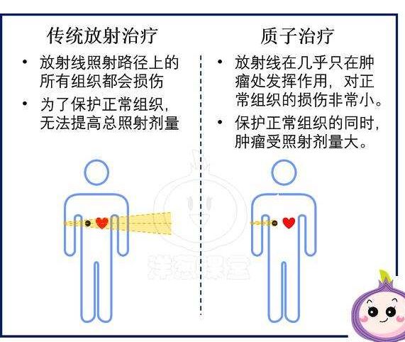 传统放疗和质子治疗对比