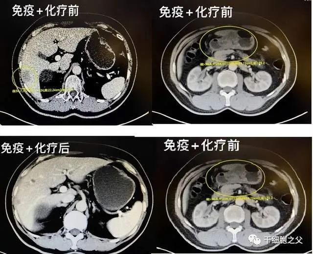 胃癌细胞免疫治疗:开启晚期患者的新希望