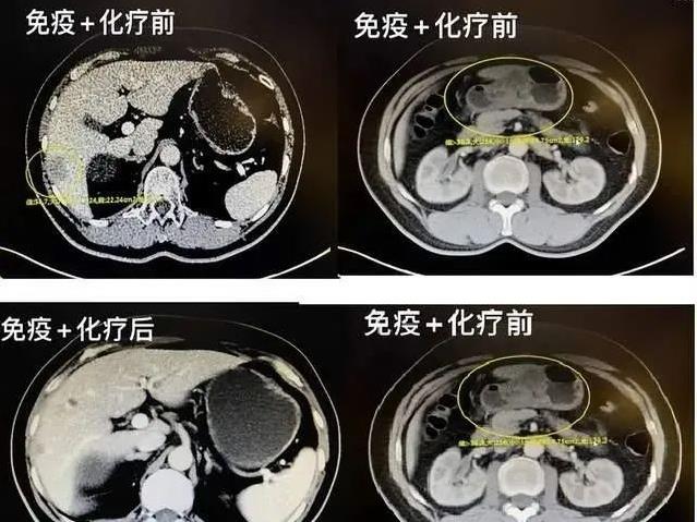 细胞免疫疗法治疗胃癌成功案例